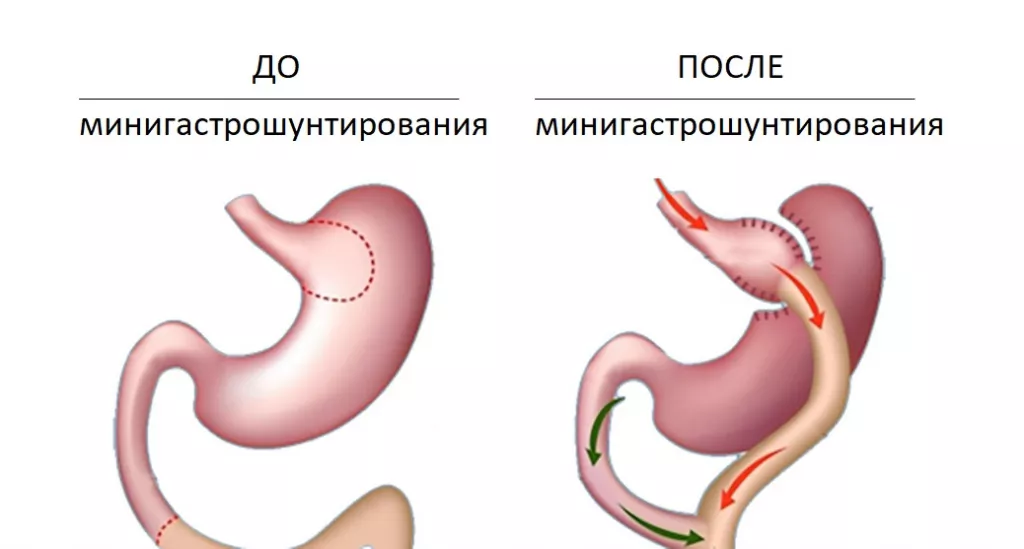 минигастрошунирование.jpg минигастрошунирование.jpg