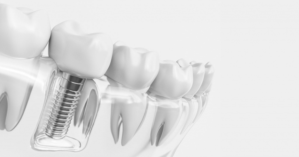 implantacziya-zubov-2-1.jpg