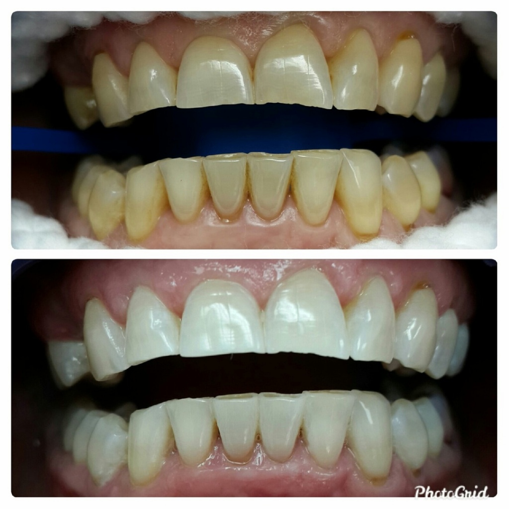 отбеливание зубов до и после zoom 4