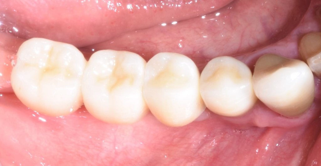 протезирование жеват гр зубов на имплантатах Astra Tech после.jpg